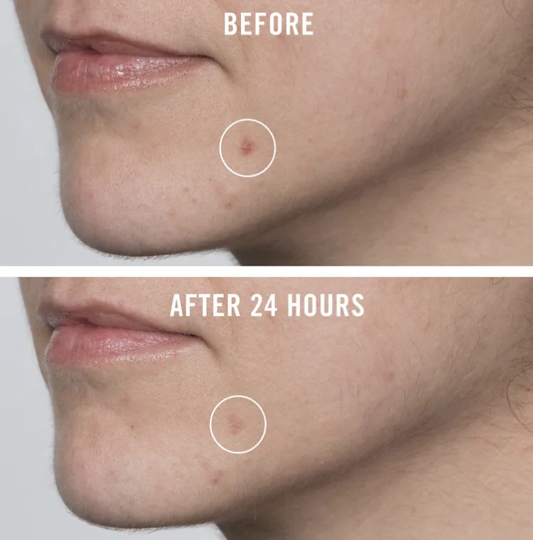 First Aid Beauty Pharma BHA Acne Spot Treatment