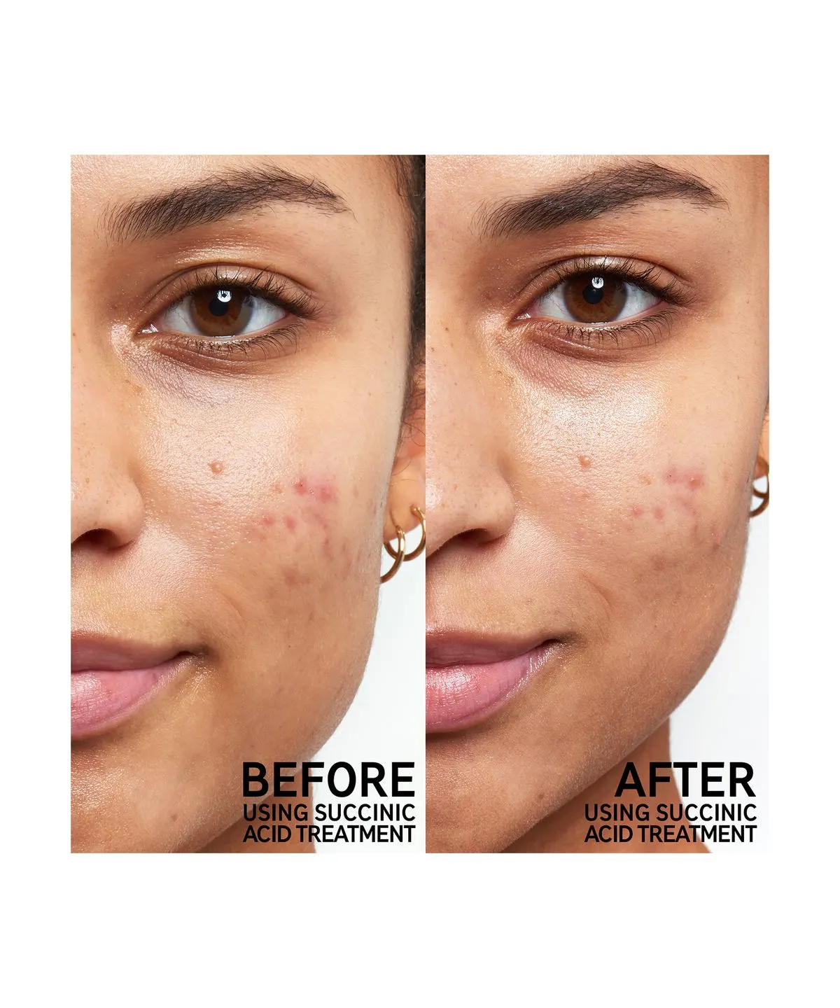 The Inkey List Succinic Acid Blemish Treatment