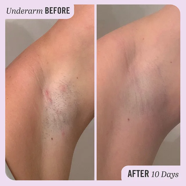 First Aid Beauty Ingrown Hair Pads With BHA & AHA