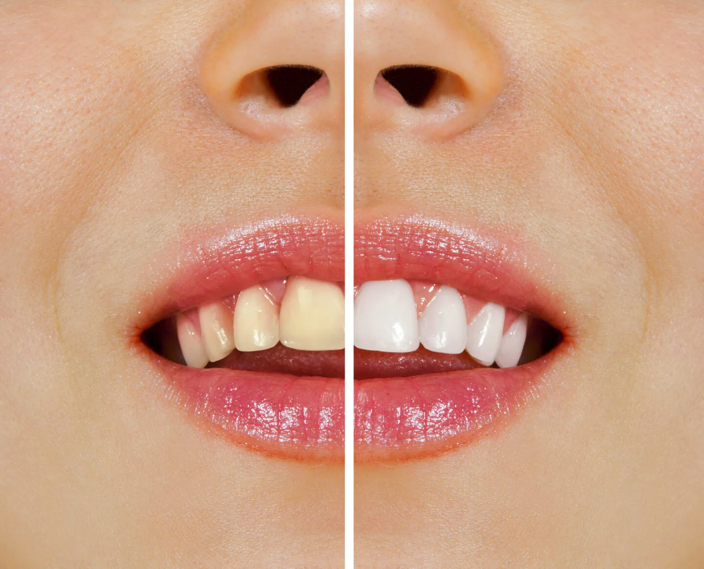 How Do Custom Whitening Trays Work In Bleaching Away Yellow Stains?