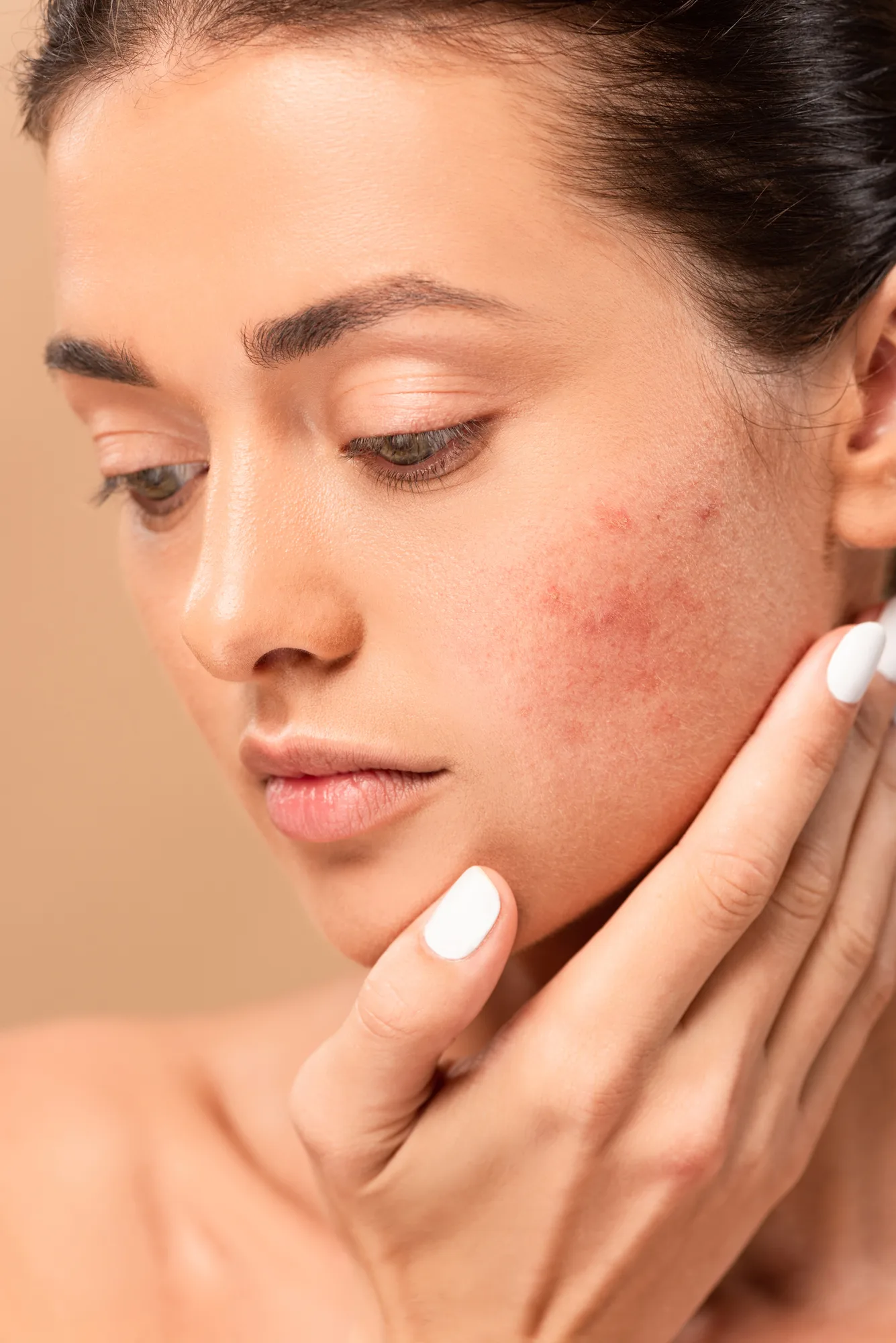 What Can You Not Do in Accutane?