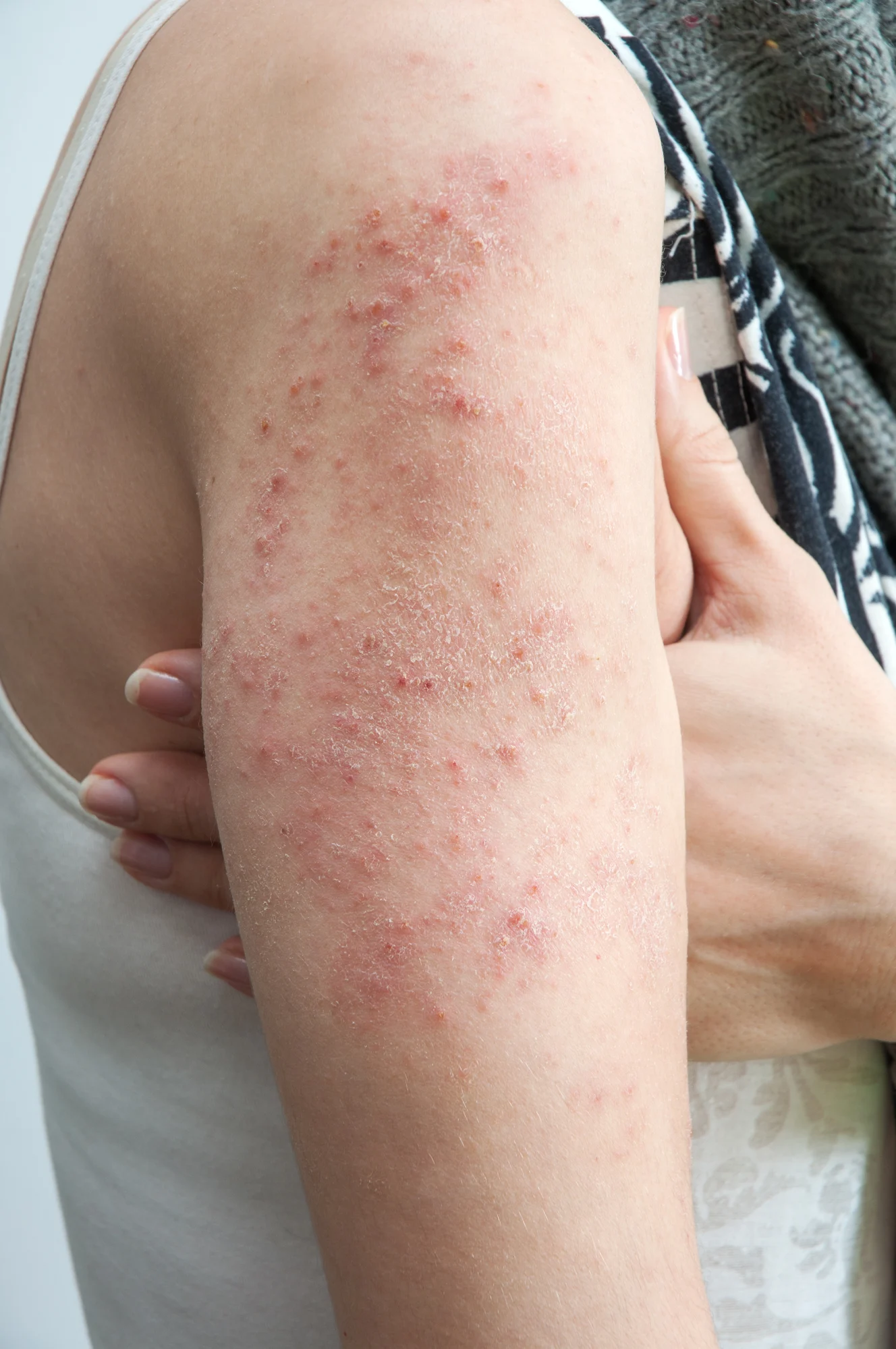 Which CeraVe Skincare Products Are Best For Eczema Flare-Ups?