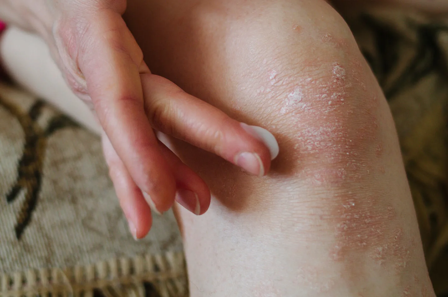 Is CeraVe Lotion Good for Eczema?
