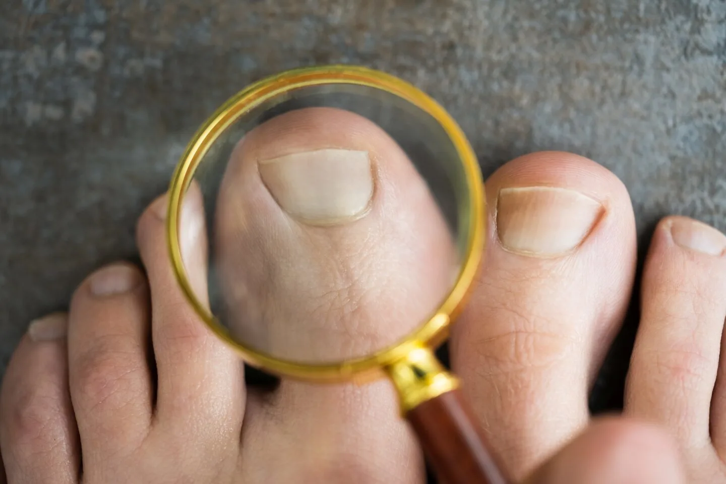 Effects Of Nutrient Deficiency On The Nails: What Do They Indicate About  Your Health?