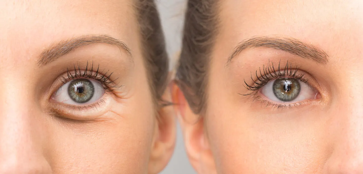 Can Chamomile Tea Bags Help With Puffy Eyes?
