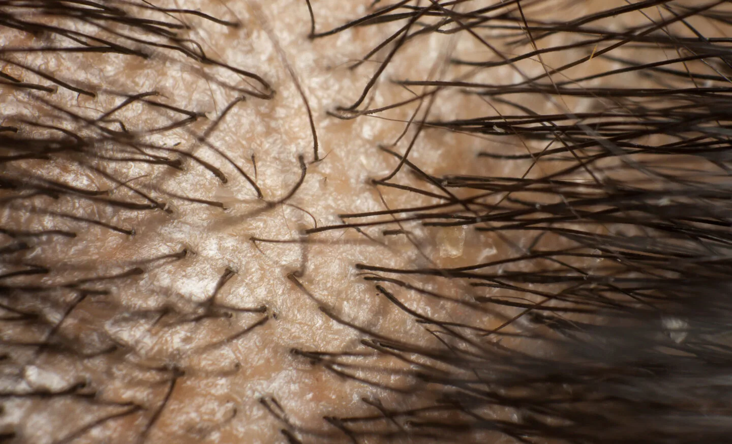 How To Reduce The Amount Of Sebum On The Scalp?