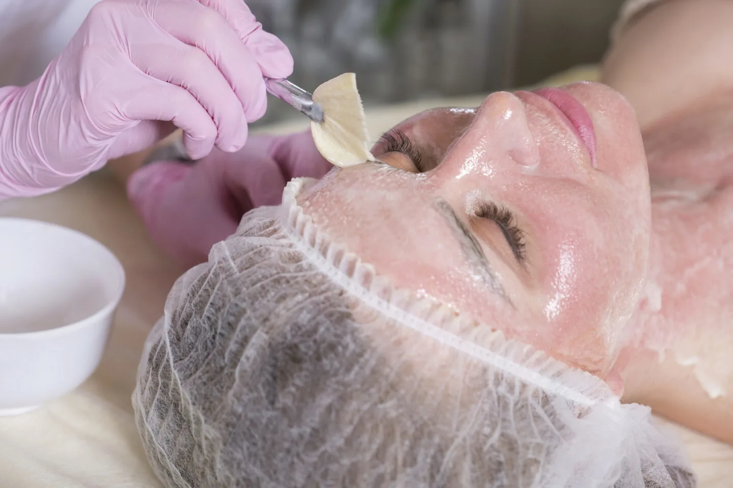 Which Is Best For Acne? Microdermabrasion Vs Chemical Peels?