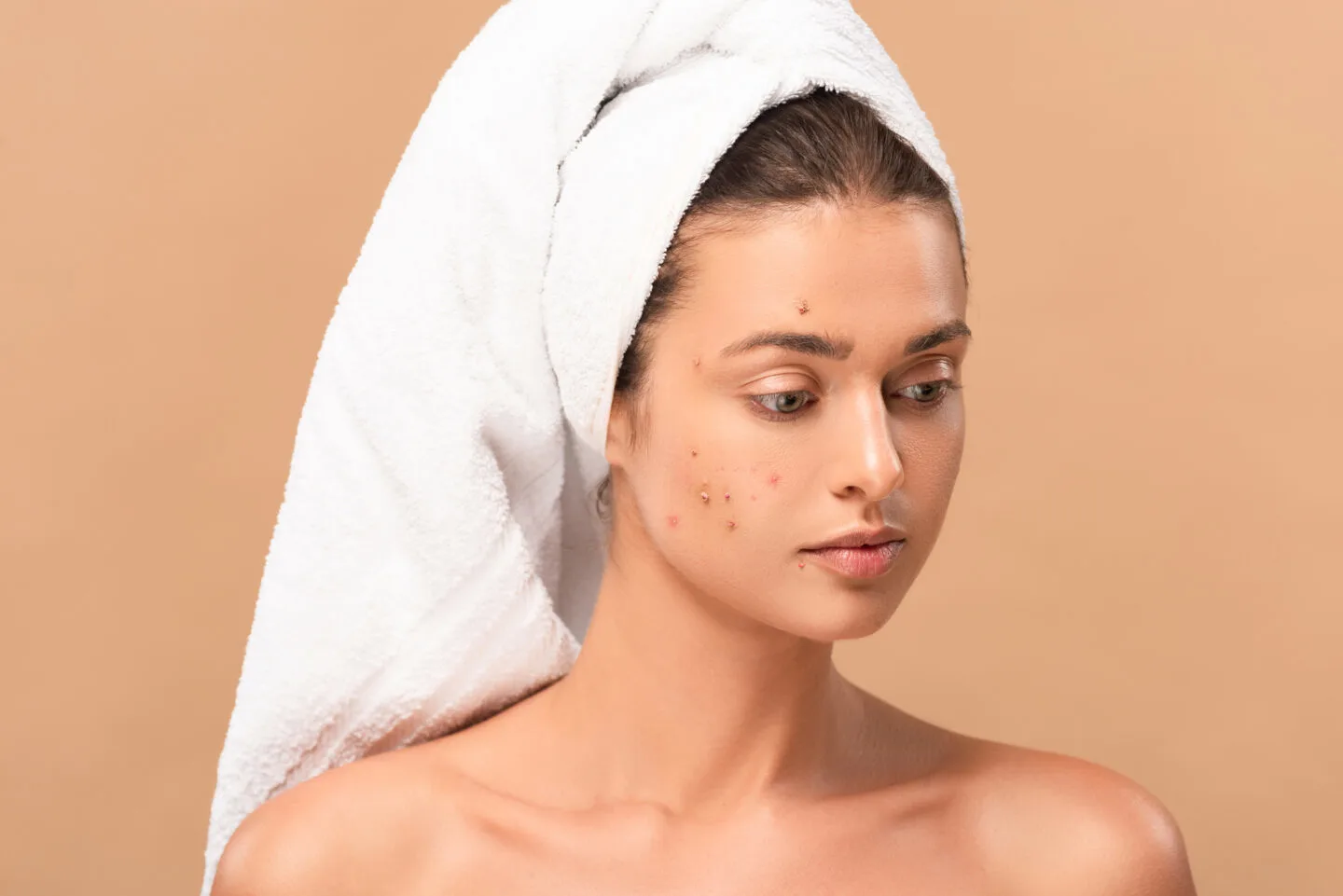Does Vaseline Help Acne?