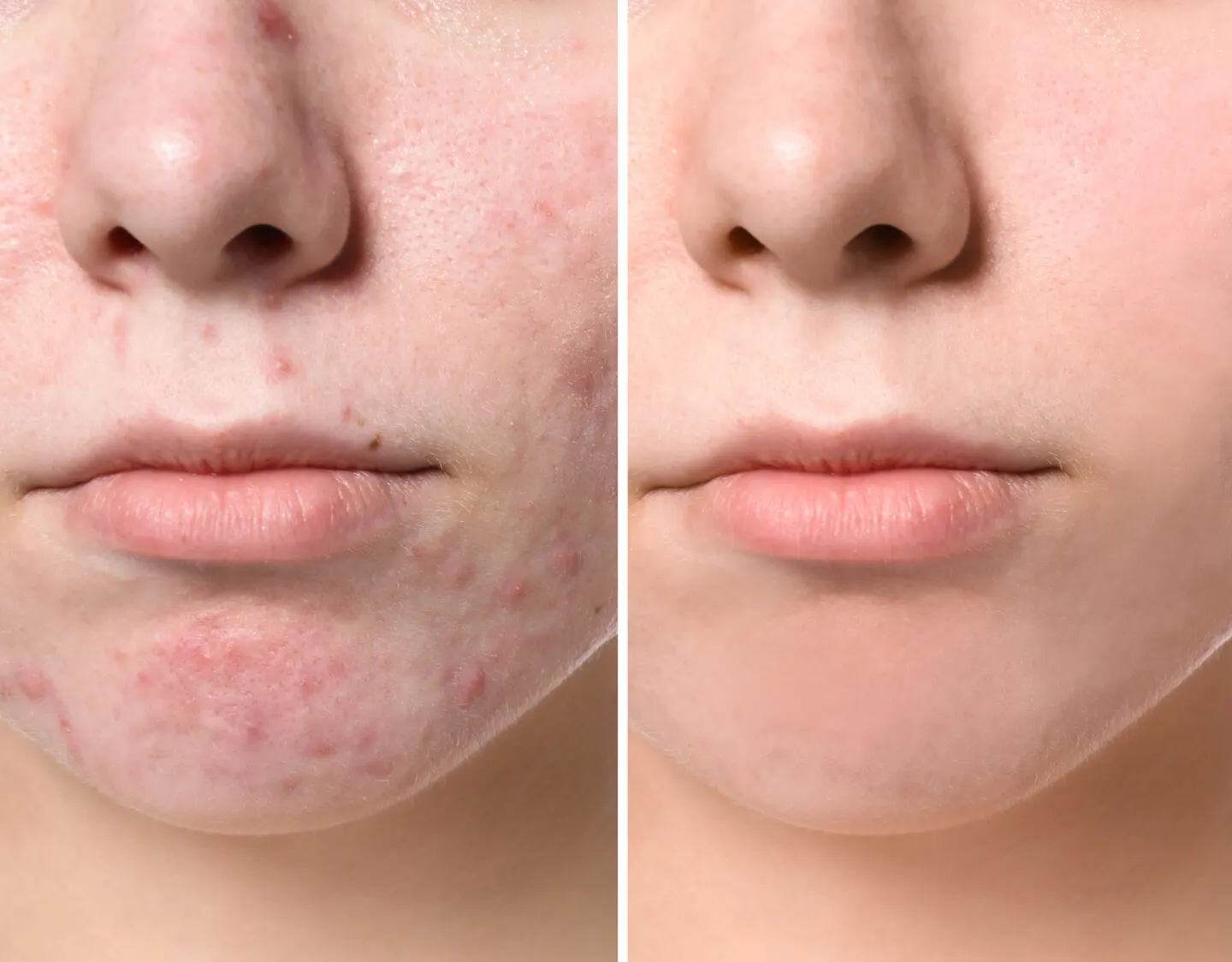 What Is A Pimple Patch?